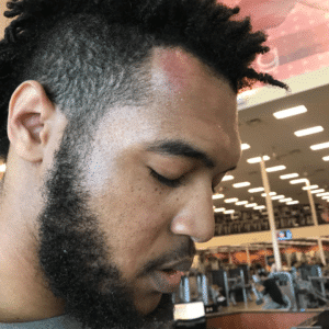 Photo of Dawkins with a contusion on his forehead.